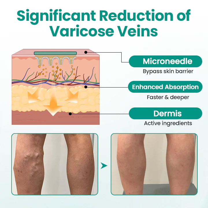 Naturbelassen® Leg Renew Patch 2 Naturbelassen® Leg Renew Patch Improve vein health and banish varicose veins with Naturbelassen® LegRenew Patch—no surgery needed! Naturbelassen® LegRenew Varicose Veins Patch is an advanced, non-invasive solution to reduce the appearance of varicose veins and improve overall vein health. Packed with anti-inflammatory and antioxidant nutrients, it boosts circulation, soothes irritation, and strengthens vein walls and valves, all while alleviating discomfort and swelling—right from the comfort of your home. Real User Testimonials "I noticed a huge difference in just two weeks!" "I've been self-conscious about my legs for years, but these patches are a total game changer. They're so comfortable to wear, and I actually started seeing my veins fade after the first week. I finally feel hopeful about my legs again." — Lisa T "No more aching legs by the end of the day!" "I work in retail and spend over eight hours a day on my feet. It’s exhausting, and my legs used to ache so badly. Since using these patches, the swelling and pain have gone down noticeably. Plus, they’re super easy to use—I just stick them on, and they do their thing." — Diane M "Why didn’t I find this sooner?" "I used to avoid wearing shorts all the time because I felt so self-conscious about my legs. Now, I actually feel confident again! It’s amazing how simple it is—I just wear the patch while I sleep, and I’ve seen incredible changes. Highly recommend it!" — Margaret S Understanding Varicose Veins: Causes and Effects Varicose veins are swollen, twisted veins that often appear on the legs and feet. They happen when the tiny valves in your veins, which keep blood flowing to your heart, become weak or damaged. This causes blood to collect in the veins, making them bulge and become visible as blue or purple lines under the skin. While they may seem like just a cosmetic issue, varicose veins can cause discomfort, heaviness, swelling, and even pain. In some cases, they can lead to skin discoloration or inflammation. Common causes include aging, genetics, pregnancy, hormonal changes, obesity, prolonged sitting or standing, and lack of exercise. Women are more likely to develop them, especially as they age. Symptoms of Varicose Veins Swelling in the legs or ankles A feeling of heaviness, pain, warmth, or tingling in the legs Visible veins that are blue or purple, often twisted or bulging Many people experience leg pain, swelling, and fatigue from varicose veins, which can disrupt daily activities and significantly reduce their quality of life. How Does the Naturbelassen® LegRenew Varicose Veins Patch Work? The Naturbelassen®LegRenew Varicose Veins Patch uses microneedling technology to create tiny skin micro-channels, ensuring deeper absorption of active ingredients. This boosts blood flow, relaxes veins, and enhances circulation for fast relief. Its anti-inflammatory properties reduce swelling while promoting vein repair, tissue regeneration, and elasticity improvement. Advanced Microneedle Technology, Easy as a Patch Each ultra-thin patch contains hundreds of microscopic needles made from skin-safe ingredients. These microneedles: Penetrate the top layer of skin (painlessly!) Deliver healing plant extracts like Safflower, Honeysuckle & Astragalus Help reduce inflammation, boost blood flow, and break up discoloration Reduce Swelling and Discomfort The Naturbelassen®LegRenew Varicose Veins Patch provides an effective solution for managing discomfort caused by varicose veins. Regular use helps alleviate inflammation, pain, redness, and heat by addressing the root issues. Its specialized formula includes ingredients that constrict blood vessels, improving blood flow and preventing pooling. This reduces swelling and offers lasting relief from edema. Boost Blood Circulation Designed to enhance overall vein health, the Naturbelassen®LegRenew Varicose Veins Patch contains active ingredients that stimulate blood flow in affected areas. When applied, it works to expand blood vessels, promoting circulation and reducing congestion. By supporting vascular health, it improves blood flow for stronger, healthier veins. Enhance Skin Appearance The Naturbelassen®LegRenew Varicose Veins Patch is an excellent choice for addressing visible vein concerns such as dilated capillaries, bruising, or telangiectasia. Infused with natural herbal extracts, this gentle yet effective formula significantly enhances the appearance of varicose veins, leaving your skin healthier and smoother. The patch’s innovative design offers immediate comfort and long-term support, making it a convenient and effective solution for improving vein health and circulation. Clinically Proven: Transforming Vein Health with Naturbelassen® LegRenew As a dermatologist, I’ve seen how frustrating it can be for patients with varicose veins when traditional treatments don’t work. Many want a safe, natural way to manage symptoms and improve vein health, which led me to create the Naturbelassen® LegRenew Varicose Veins Patch. For over five years, it has helped thousands improve circulation, reduce swelling, and ease discomfort. Made with premium natural ingredients, Naturbelassen® LegRenew provides a non-invasive option to support vein health, restore comfort, and boost confidence. It’s been rewarding to witness how Naturbelassen® LegRenew has transformed so many lives. Why Choose Naturbelassen®LegRenew Varicose Veins Patch? Reduce Visible Veins: Effectively minimize the appearance of varicose and spider veins for smoother, healthier-looking legs. Relieve Discomfort: Alleviate pain, heaviness, and fatigue with targeted relief designed to comfort tired, aching legs. Boost Circulation: Enhance blood flow and decrease swelling, promoting healthier and more energized legs. Support Vein Health: Strengthen vein walls and help prevent further dilation for lasting vascular health. Nourish Skin: Hydrate and soothe dry, irritated skin, leaving it revitalized with a smoother texture. Safe & Gentle Care: Enjoy clinically proven results free from harmful ingredients or side effects, suitable for sensitive skin. Convenient & Non-Invasive: Easy to use at home, day or night, for instant relief and ongoing support. Ethically Developed: Cruelty-free formulation created in FDA-registered laboratories in the United States. The Power of Natural Ingredients Each patch contains natural, clinically-backed ingredients to address varicose veins and support skin health. Safflower, rich in fatty acids and antioxidants, hydrates the skin, soothes irritation, enhances texture, and reduces redness. Astragalus revitalizes and heals by boosting circulation and strengthening blood vessels for healthier veins. Honeysuckle calms and nourishes with anti-inflammatory and antioxidant properties, easing swelling, redness, and irritation. Licorice soothes skin, brightens dull areas, and reduces redness with powerful anti-inflammatory benefits. Salvia, or sage, enhances circulation, relieves swelling, and protects skin and veins with antioxidant benefits. Angelica nourishes, improves blood flow, and calms inflammation, promoting smoother, healthier skin. How to Use Step 1: Ensure the skin is clean and dry. Remove the patch and firmly apply it to the affected area. Step 2: After application, keep the area as still as possible for optimal results. The patch will start working within minutes. Step 3: Once the patch is securely applied, you can go about your daily activities. Tips for Best Results: For best results, apply the Naturbelassen®LegRenew Varicose Veins Patch to clean, dry skin, ensuring any skincare products are fully absorbed, and wear it for the recommended duration. Product Specifications: Ingredients: Safflower, Astragalus, Honeysuckle, Licorice, Salvia, Angelica Net Weight: 1 bag containing 8 patches GooShopo: Trusted Worldwide for Smart, Secure Shopping GooShopo is a trusted eCommerce platform offering high-quality products at exceptional value. Established in 2019, we focus on consistent product standards, secure order processing, and dependable international delivery. Our platform is designed for customers who demand efficiency, transparency, and premium service with every purchase. Shipping Details All orders are processed within 3-5 business days. Delivery time typically ranges from 2-3 weeks depending on your location. Each shipment includes tracking details to keep you informed at every stage. Easy Returns We offer a 30-day return policy for eligible items. Customers may return unused products in original condition. Return shipping costs are the responsibility of the buyer. Our support team is available to assist with any return request. 100% Money-Back Guarantee Your satisfaction is our priority. If a product does not meet your expectations, GooShopo will provide a full refund or a replacement, ensuring a secure and risk-free shopping experience. ABOUT US SHIPPING POLICY REFUND&RETURNS POLICY CONTACT US
