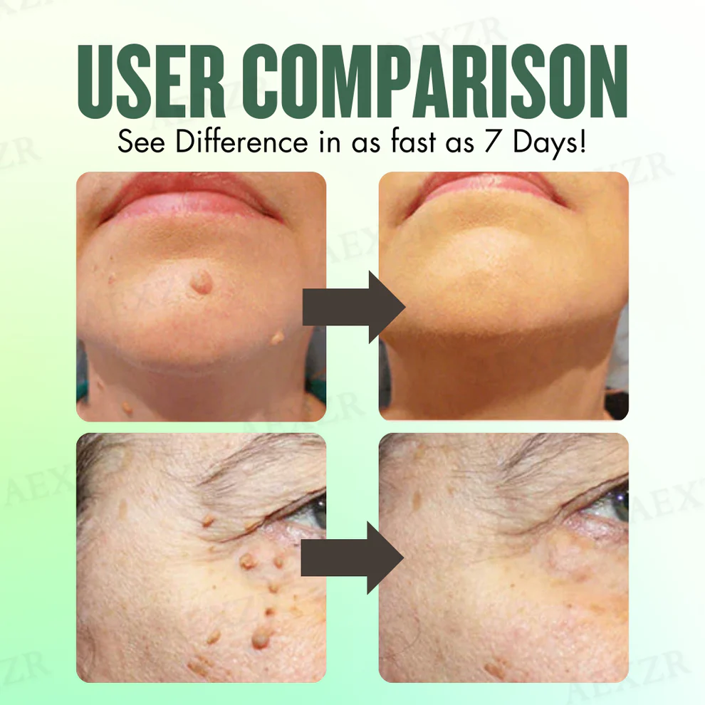 AEXZR® WartsOff Instant Blemish Removal Cream 2 AEXZR® WartsOff Instant Blemish Removal Cream