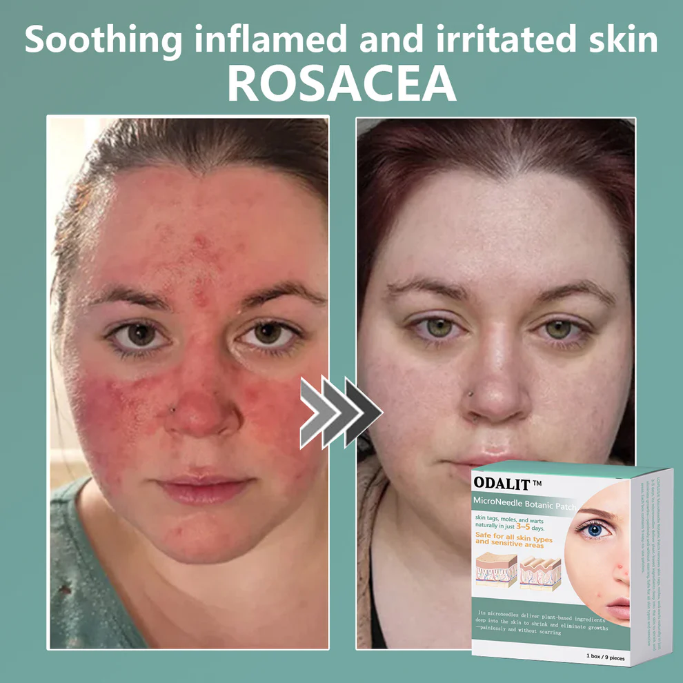 ODALIT™ MicroNeedle Botanic skin Tag Removal Patch 6 ODALIT™ MicroNeedle Botanic skin Tag Removal Patch