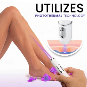 Bikenda® Varicose Vein Photothermal Laser Treatment 10 Bikenda® Varicose Vein Photothermal Laser Treatment