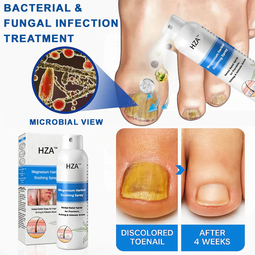 HZA™ Magnesium Herbal Psoriasis Spray 12 HZA™ Magnesium Herbal Psoriasis Spray