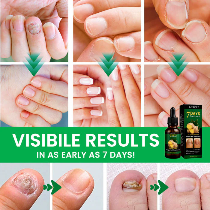 AEXZR® Fungal Nail Treatment 6 AEXZR® Fungal Nail Treatment