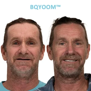 BQYOOM™ Dentures | Invisible Comfort, Natural Grip 12 BQYOOM™ Dentures | Invisible Comfort, Natural Grip
