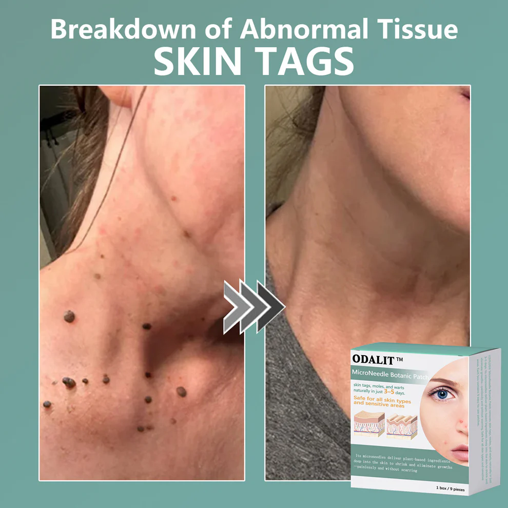 ODALIT™ MicroNeedle Botanic skin Tag Removal Patch 8 ODALIT™ MicroNeedle Botanic skin Tag Removal Patch