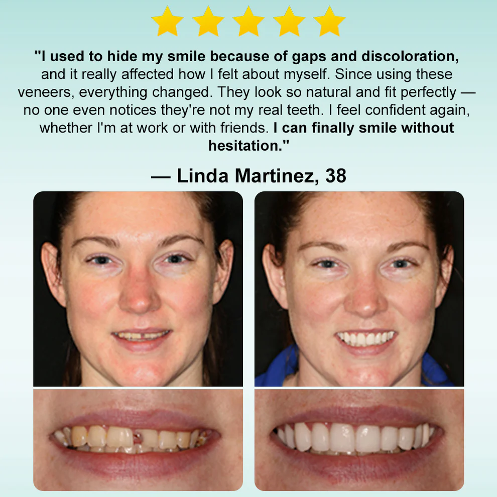 Ourlyard® Instant Stick on Dental Veneers 8 Ourlyard® Instant Stick on Dental Veneers