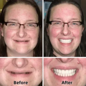 LAOZIK™-Advanced Custom-Fit Functional Dentures 12 LAOZIK™-Advanced Custom-Fit Functional Dentures