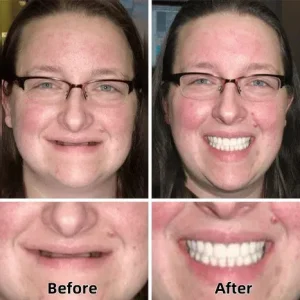 ROSOPL™-Advanced Custom-Fit Functional Dentures 19 ROSOPL™-Advanced Custom-Fit Functional Dentures