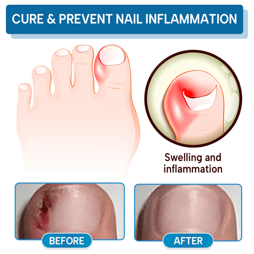 Lyyeto® OnyxiGuard Fungal Repair Herbal Spray ACE 6 Lyyeto® OnyxiGuard Fungal Repair Herbal Spray ACE