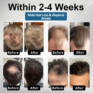 ATTDX® Hair Reawaken PP405 Roll-On Serum 11 ATTDX® Hair Reawaken PP405 Roll-On Serum