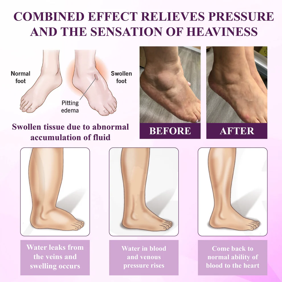 ATTDX® NightDrain Leg Therapy Edema Cream 7 ATTDX® NightDrain Leg Therapy Edema Cream