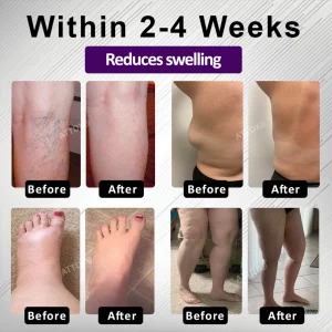 ATTDX® Night-Time Edema Relief Sleep Cream 11 ATTDX® Night-Time Edema Relief Sleep Cream