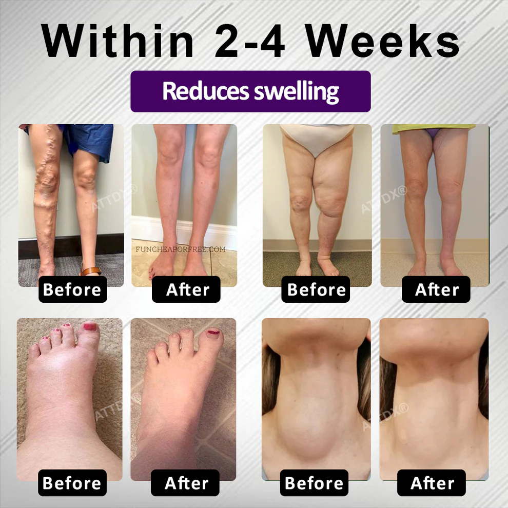 ATTDX® NightDrain Leg Therapy Edema Cream 3 ATTDX® NightDrain Leg Therapy Edema Cream