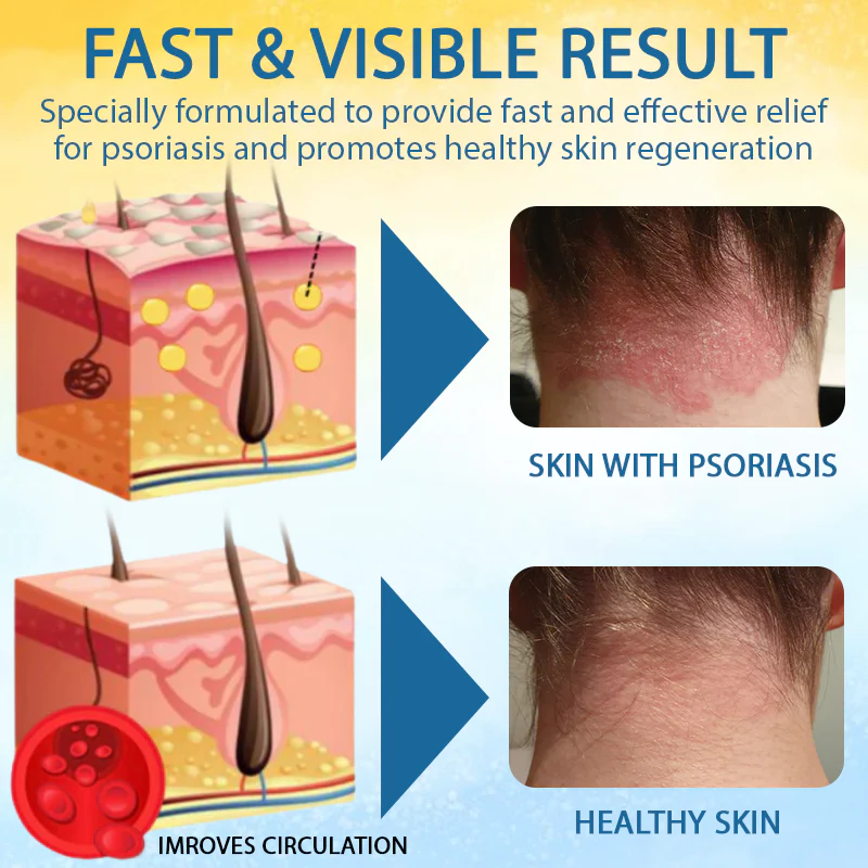 Croaie® PsoriasisCare Mellifera Venom Skin Healing Spray 5 Croaie® PsoriasisCare Mellifera Venom Skin Healing Spray