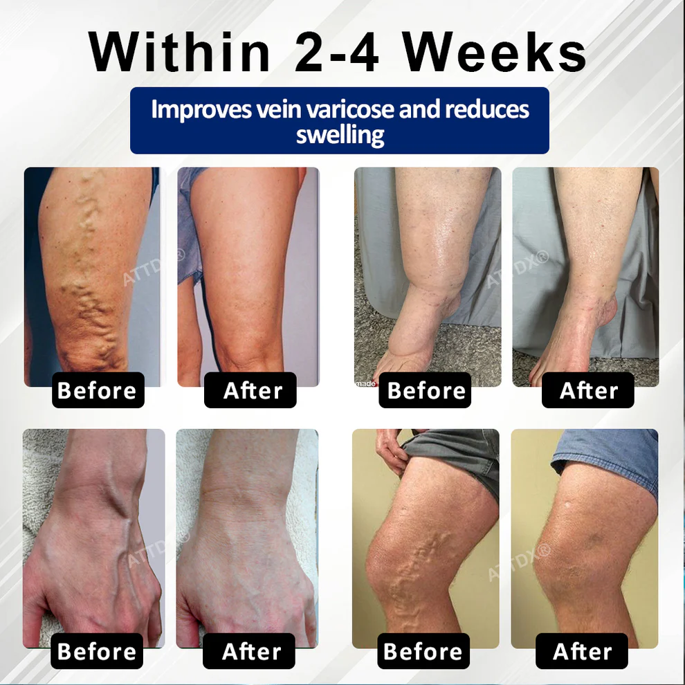 ATTDX® VeinFocus Microneedle Leg Patch 2 ATTDX® VeinFocus Microneedle Leg Patch