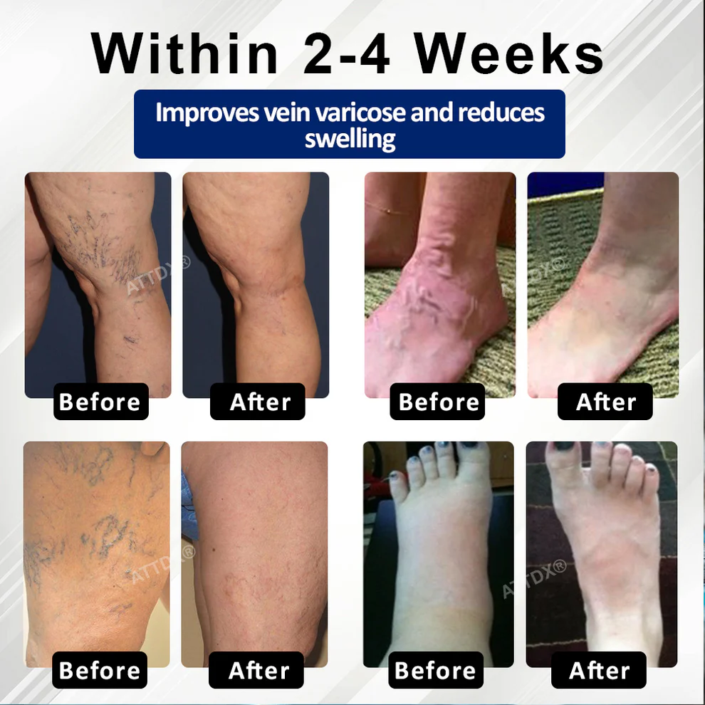 ATTDX® VeinFocus Microneedle Leg Patch 3 ATTDX® VeinFocus Microneedle Leg Patch