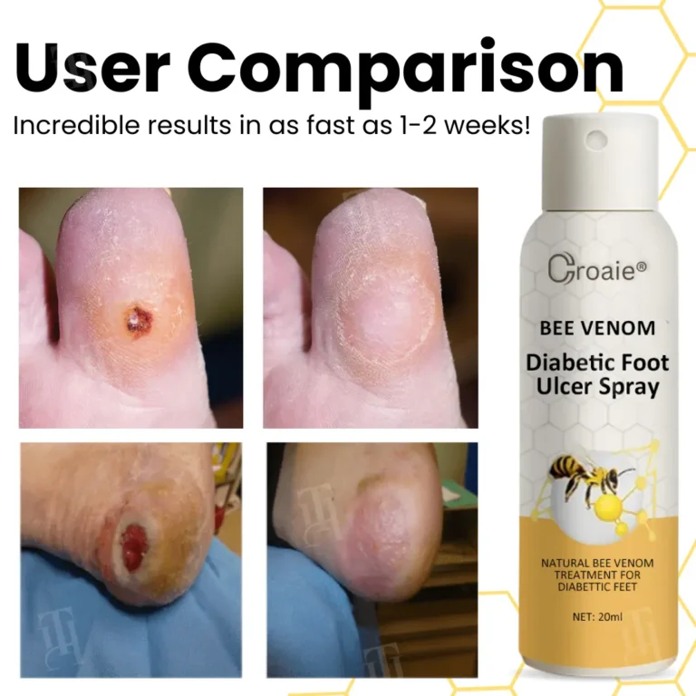 Croaie® Bee Venom Diabetic Foot Ulcer Spray 2 Croaie® Bee Venom Diabetic Foot Ulcer Spray