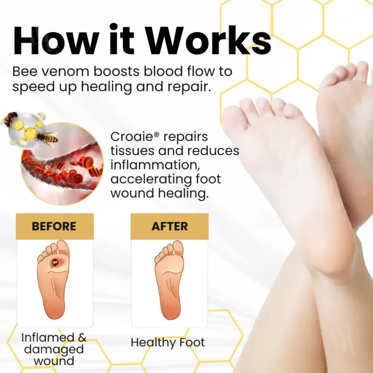 Croaie® Bee Venom Diabetic Foot Ulcer Spray 4 Croaie® Bee Venom Diabetic Foot Ulcer Spray