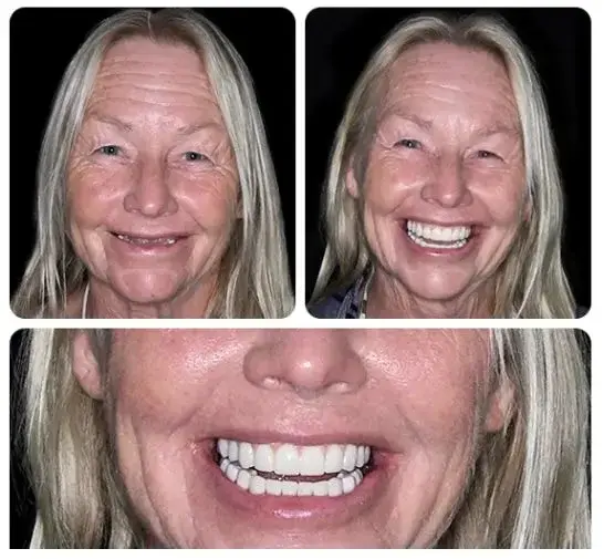 BQYOOM™-Custom-Fit Functional Dentures — Combination pack 3 BQYOOM™-Custom-Fit Functional Dentures — Combination pack