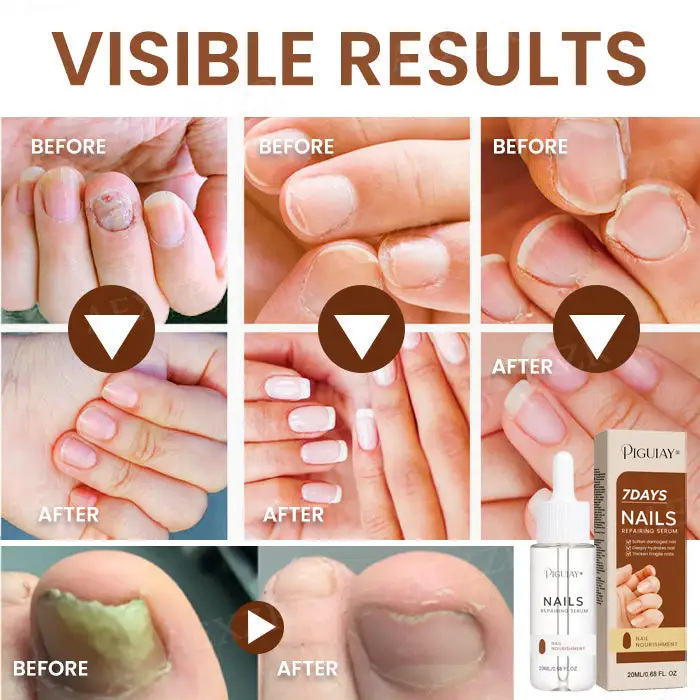 Piguiay® Nails Repairing Serum 4 Piguiay® Nails Repairing Serum