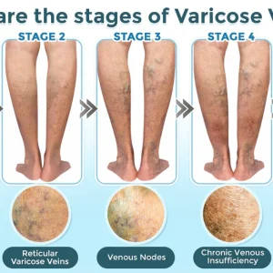 GFOUK® VenaRestore MicroNeedle Vein Repair Patch