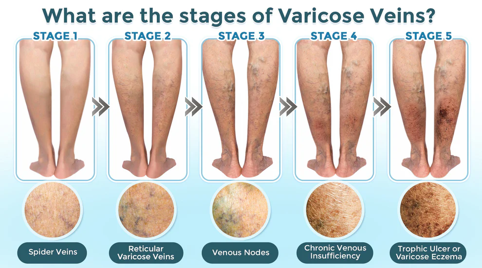GFOUK® VenaRestore MicroNeedle Vein Repair Patch