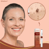 DermaLift™ Pen | Removes warts and age spots 29 DermaLift™ Pen | Removes warts and age spots