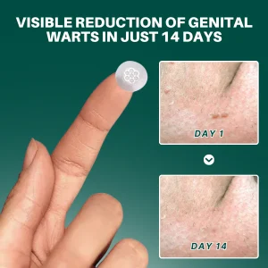 ODALIT™ Genital Wart Removal Patch 9 ODALIT™ Genital Wart Removal Patch