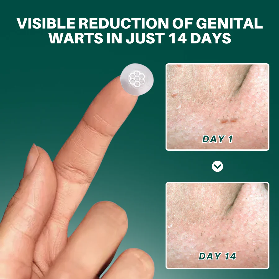 ODALIT™ Genital Wart Removal Patch 4 ODALIT™ Genital Wart Removal Patch