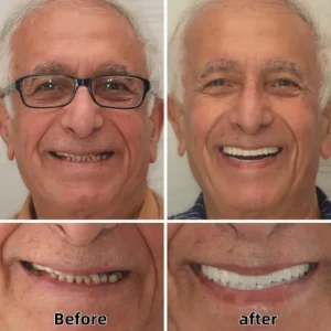 ROSOPL™ Custom Functional Denture Kits 16 ROSOPL™ Custom Functional Denture Kits