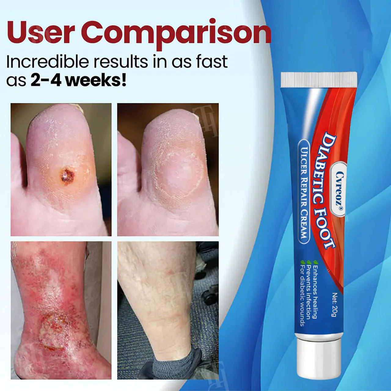 Cvreoz® Diabetic Foot Ulcer Repair Cream 4 Cvreoz® Diabetic Foot Ulcer Repair Cream - Image 4
