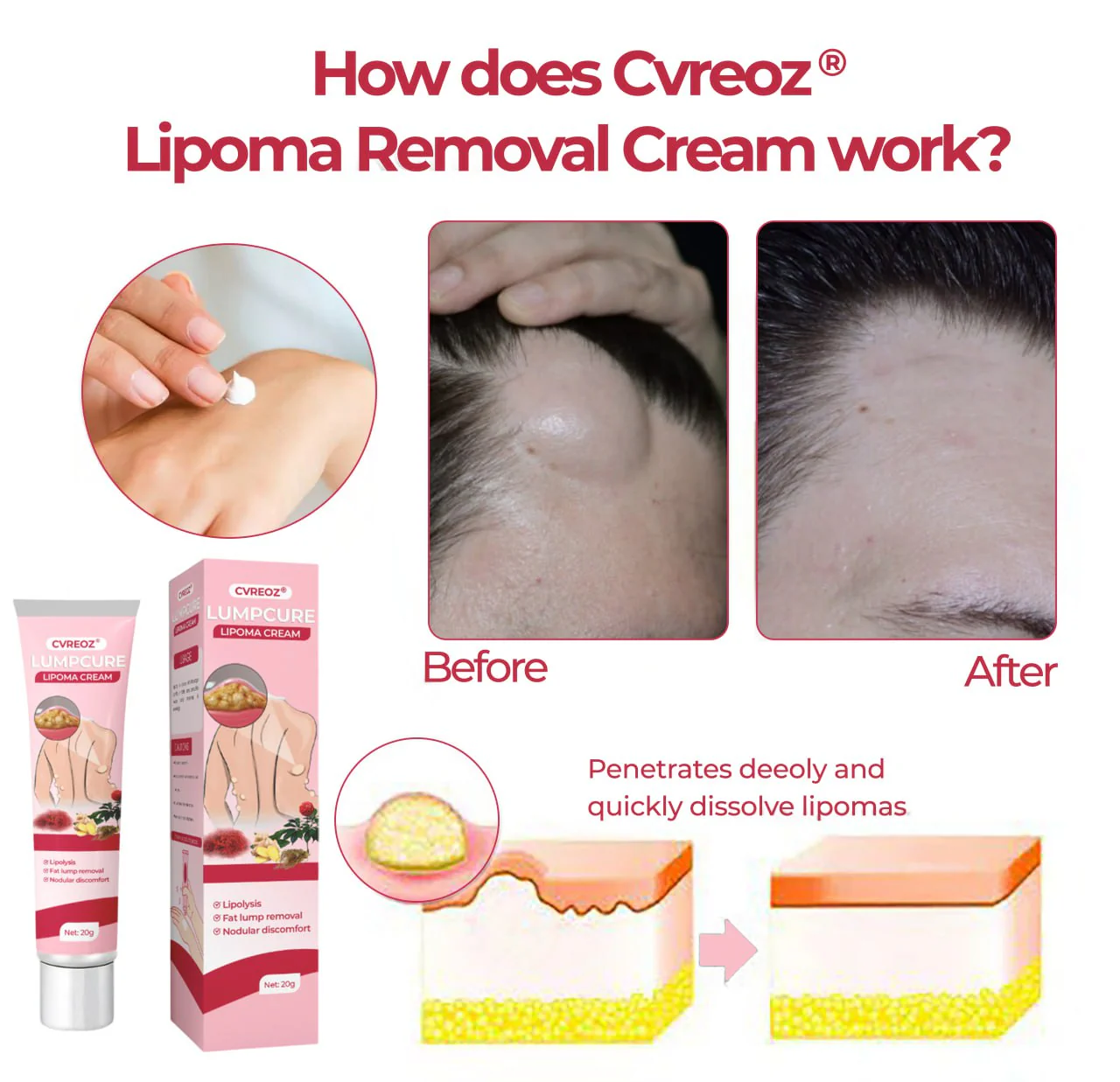 CVREOZ® LumpCure Lipoma Cream 3 CVREOZ® LumpCure Lipoma Cream - Image 3