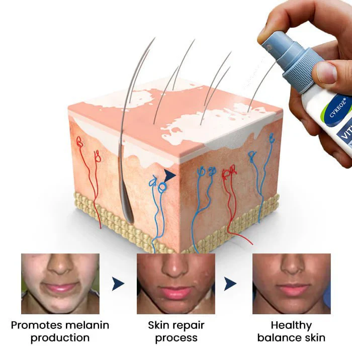 Cvreoz® Vitiligo Treatment Spray 5 Cvreoz® Vitiligo Treatment Spray - Image 5