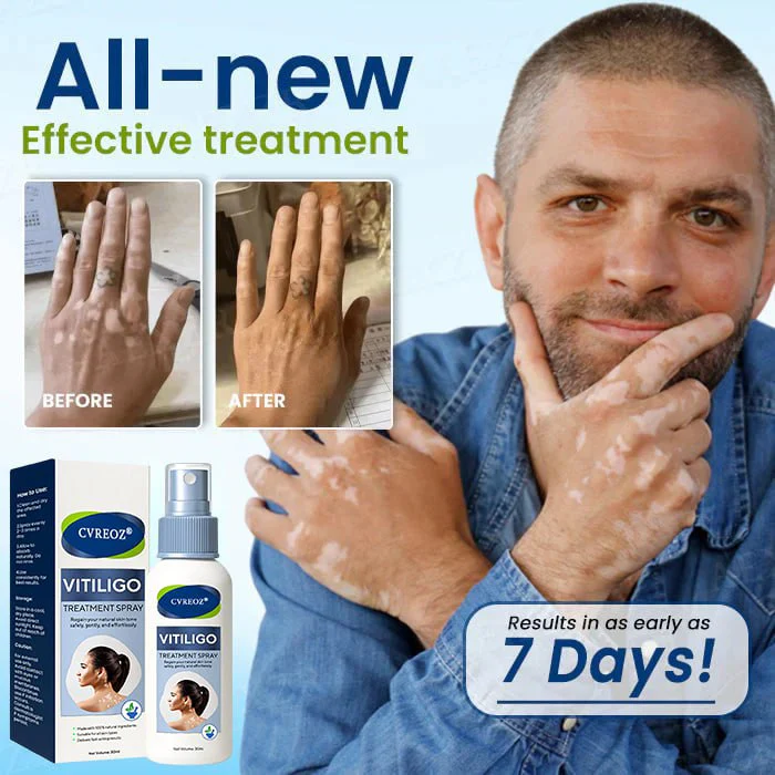 Cvreoz® Vitiligo Treatment Spray 3 Cvreoz® Vitiligo Treatment Spray