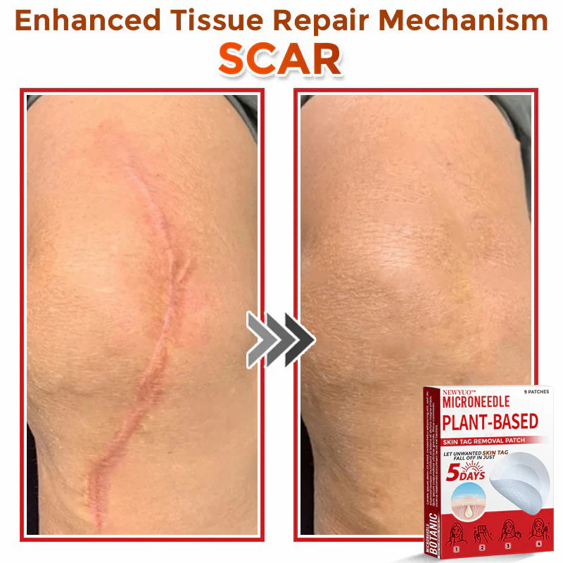 Newyuo® MicroNeedle Botanic Skin Tag Removal Patch 11 Newyuo® MicroNeedle Botanic Skin Tag Removal Patch