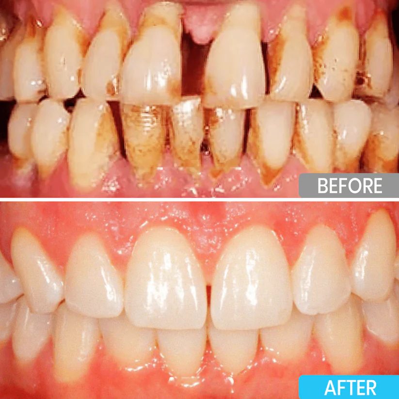 Lyyeto® Focussmile bee venom treatment powder for oral use 3 Lyyeto® Focussmile bee venom treatment powder for oral use