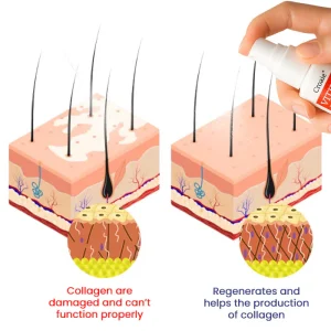 Croaie® Vitiligo Treatment Spray - No allergies 10 Croaie® Vitiligo Treatment Spray - No allergies