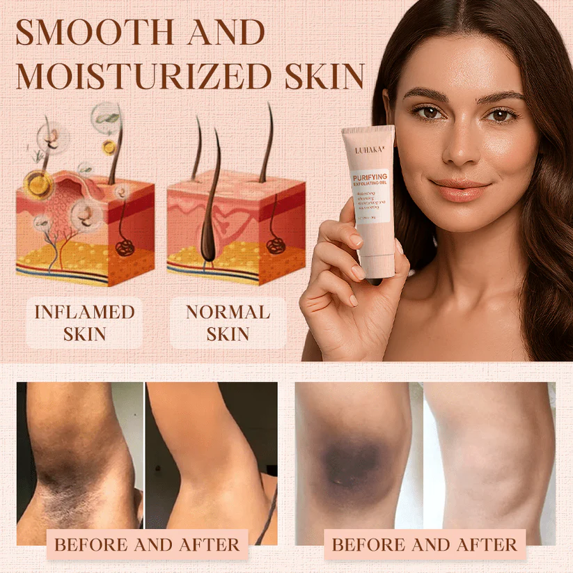 Luhaka® Purifying Exfoliating Gel for Acanthosis Nigricans 2 Luhaka® Purifying Exfoliating Gel for Acanthosis Nigricans