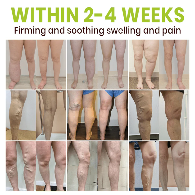 Lyyeto® Professional Leg Circulation Cream 2 Lyyeto® Professional Leg Circulation Cream