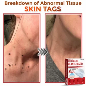 Newyuo® MicroNeedle Botanic Skin Tag Removal Patch 22 Newyuo® MicroNeedle Botanic Skin Tag Removal Patch