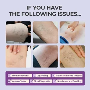 AQA™ Leg Relief Varicose Veins Cream 11 AQA™ Leg Relief Varicose Veins Cream