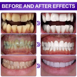 Flysmus® V34 Whitening Strips
