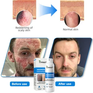 Cvreoz® Magnesium Herbal Psoriasis Spray