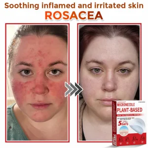 Newyuo® MicroNeedle Botanic Skin Tag Removal Patch 23 Newyuo® MicroNeedle Botanic Skin Tag Removal Patch