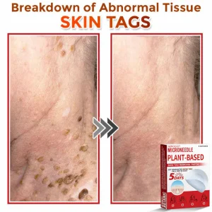 Newyuo® MicroNeedle Botanic Skin Tag Removal Patch 25 Newyuo® MicroNeedle Botanic Skin Tag Removal Patch