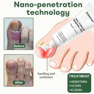 Dobshow® Nail Fungus Renewal Gel 9 Dobshow® Nail Fungus Renewal Gel