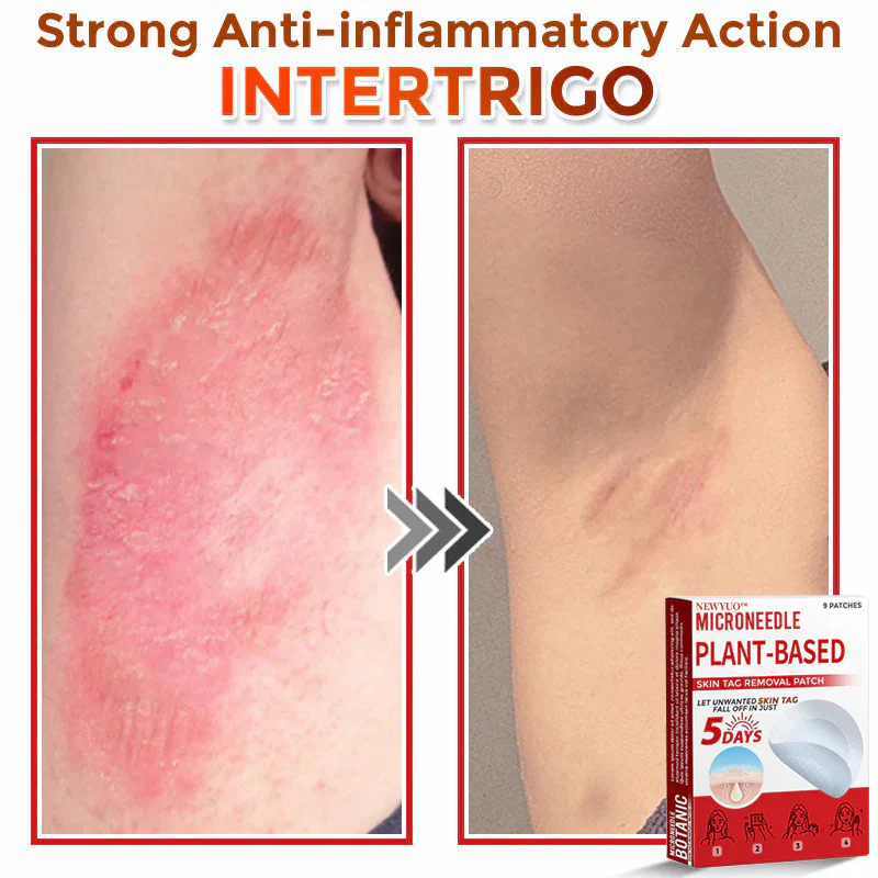 Newyuo® MicroNeedle Botanic Skin Tag Removal Patch 13 Newyuo® MicroNeedle Botanic Skin Tag Removal Patch