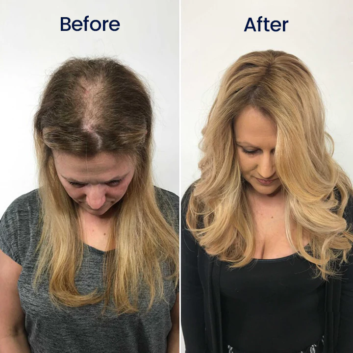 Biancat® Maximum Strength 5% Minoxidil Fast-Action Hair Growth Serum 4 Biancat® Maximum Strength 5% Minoxidil Fast-Action Hair Growth Serum