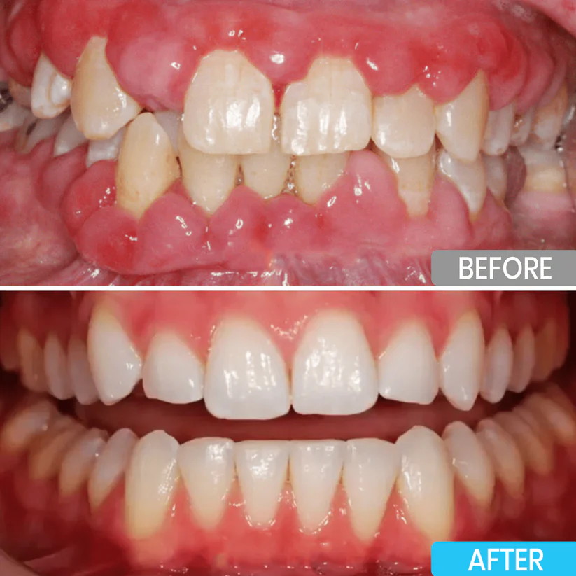 Lyyeto® Focussmile bee venom treatment powder for oral use 2 Lyyeto® Focussmile bee venom treatment powder for oral use