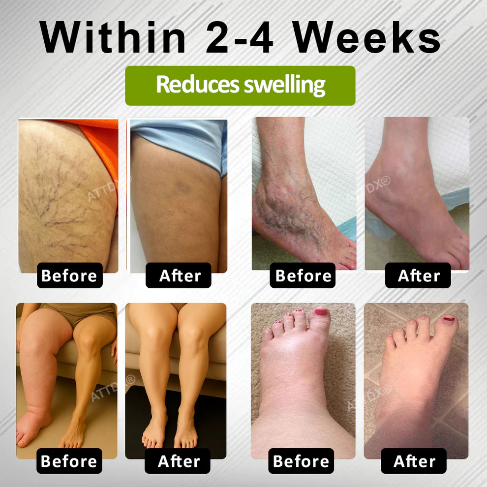 ATTDX® Fluid Regulation Edema Care Cream 2 ATTDX® Fluid Regulation Edema Care Cream