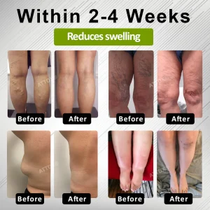 ATTDX® Fluid Regulation Edema Care Cream 12 ATTDX® Fluid Regulation Edema Care Cream